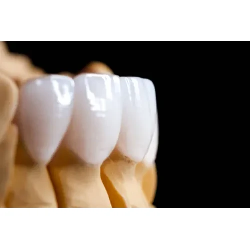 VENEER 1 TOOTH