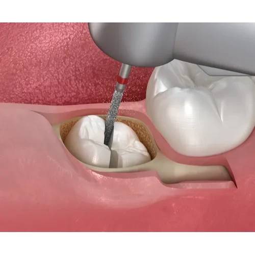 SURGICAL EXTRACTION