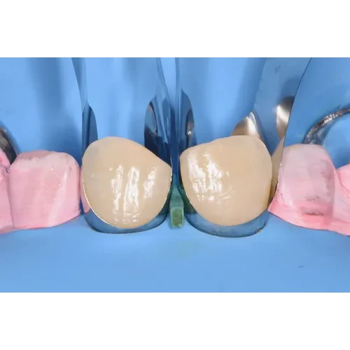 ANTERIOR FILLING