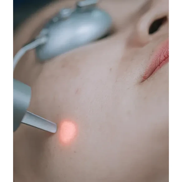 Fractional laser