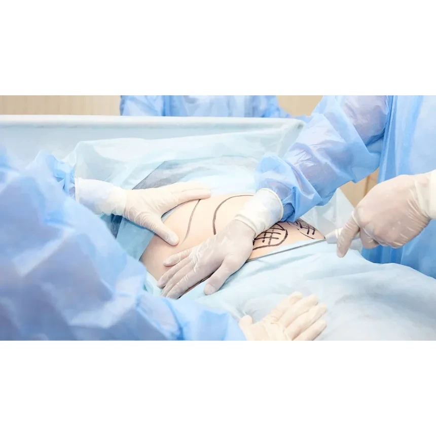 Liposuction operations and surgery