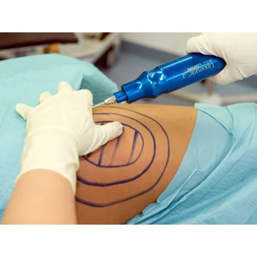 Abdominal liposuction