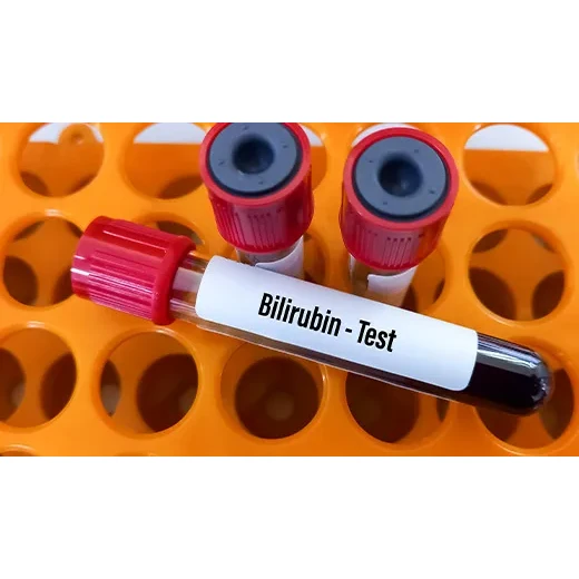 Bilirubin - Direct