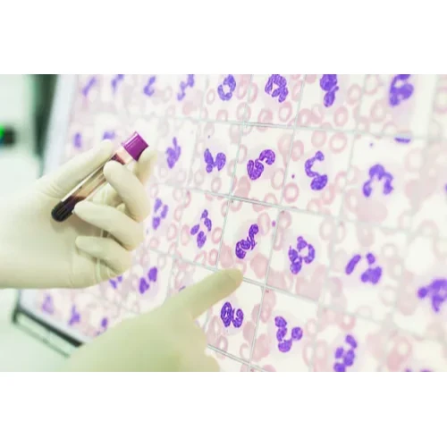 Peripheral Blood Smear